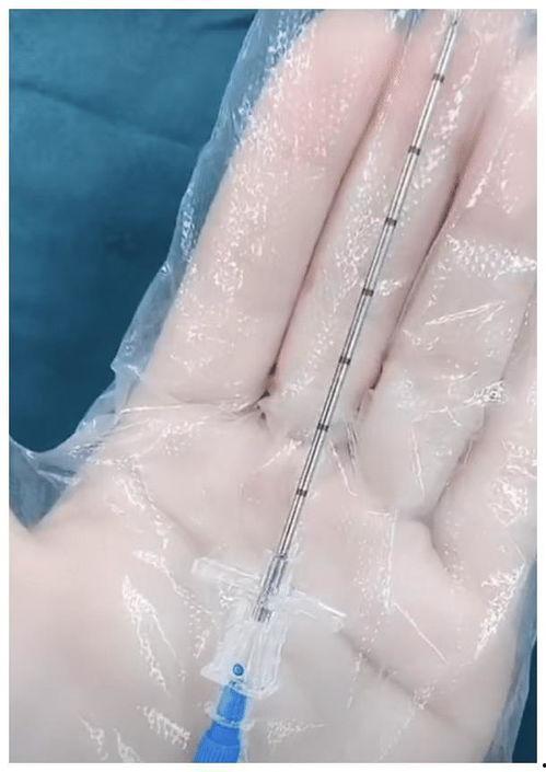 剖腹产打麻药视频,安全无痛的分娩之旅